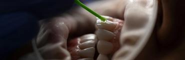 Restorative dental treatment